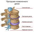 Дифузна протрузія диска що це таке