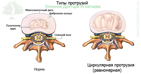 Циркулярна протрузія